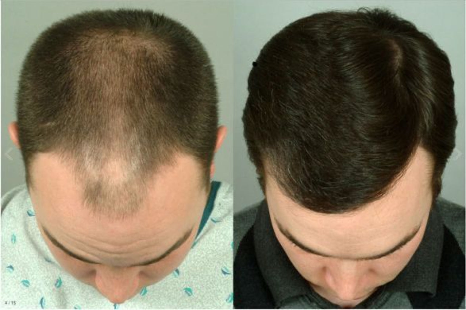Before and after comparison of hair loss treatment on a person's head.